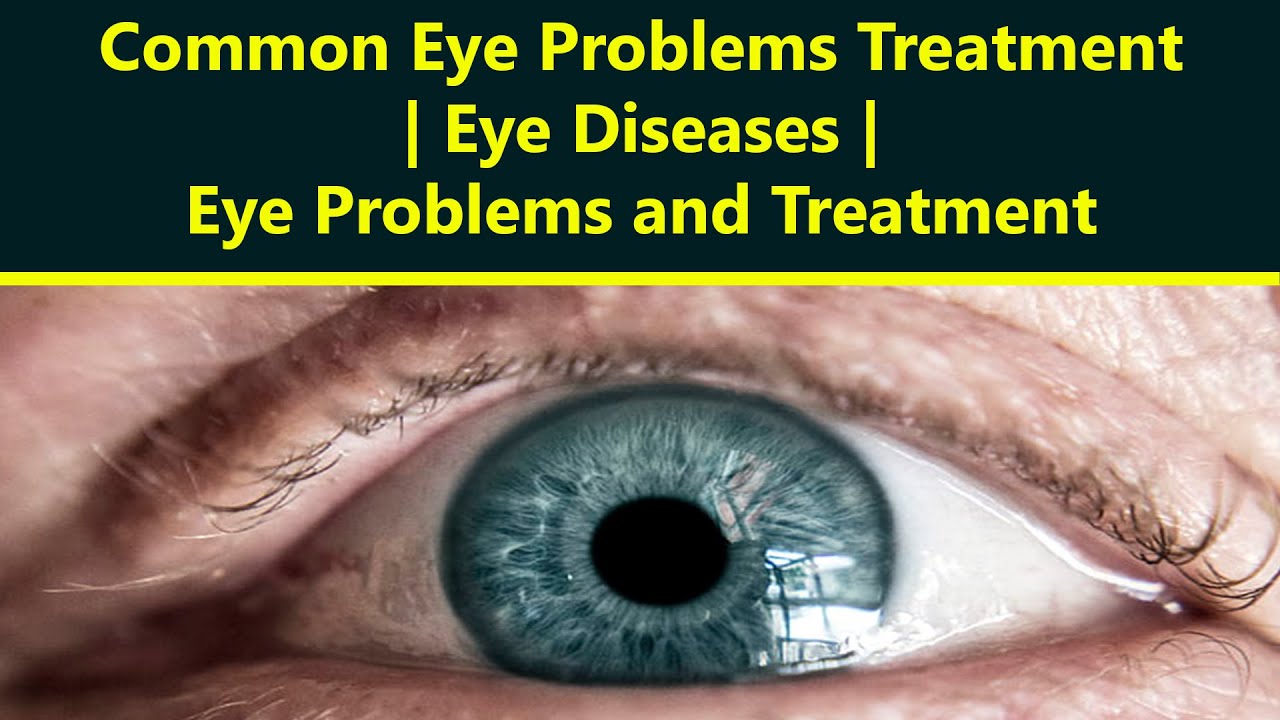 Common eye conditions – Vision Express